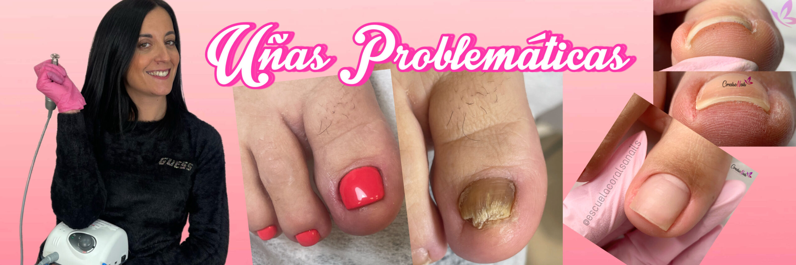 Curso online Pedicura Profesional Uñas Problemáticas de CoralSanais