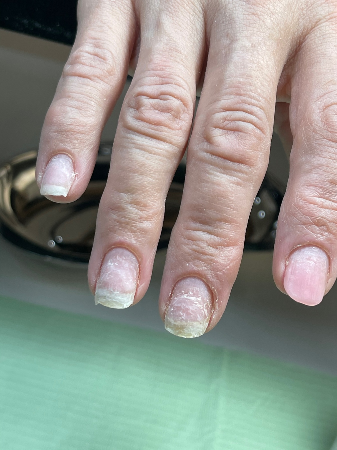 Vista inicial de las uñas naturales del caso, antes de la manicura.